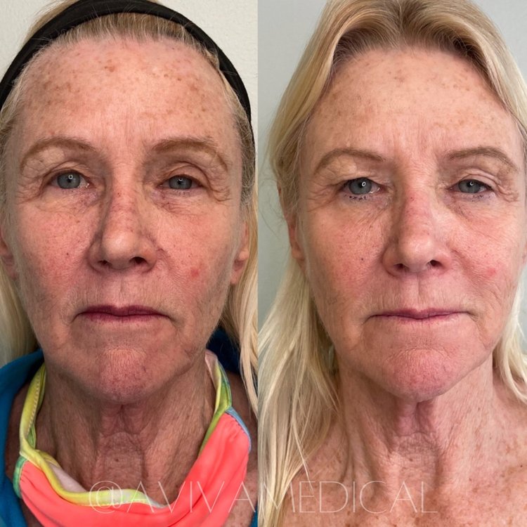 Before and After treatment result on the Face of a Women | Aviva Med Spa in Centennial, CO