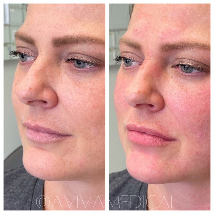 Before and After treatment result on the Face of a Women | Aviva Med Spa in Centennial, CO